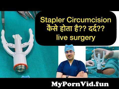 ZSR Circumcision live operation | How stapler circumcision is done | phimosis treatment | from sunat khatna Watch Video - MyPornVid.fun