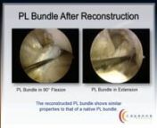 Dr Franco Webinar - Restoring the ACL Footprint with AperFix from aper