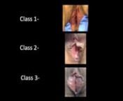 2016 Videofest 24 nNOVEL CLASSIFICATION OF LABIA ANATOMY IN THE EVALUATION AND TREATMENT OF VAGINAL AGGLUTINATION nM. L. Nieto1,2; T. Brueseke1,2; C. Wu3; E. Geller1,2; D. Zolnoun1,2,3 n1Urogynecology, UNC, Chapel Hill , NC, 2Obstetrics &amp; Gynecology, UNC, Chapel Hill, NC, 3Plastic Surgery, UNC, Chapel Hill , NC.