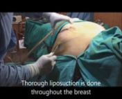 Very large Man boobs or Gynaecomastia or Male breasts surgery video shows surgery totally under local anesthesia by tumescent &#39;awake&#39; technique. It is done like an OPD procedure. There is no need for admission in hospital. Patients come after light breakfast and go home immediately after surgery. It is a painless and virtually bloodless surgery technique. Surgery dressings are removed after two days. International patients can go back after two days of surgery. Results are permanent.