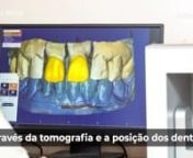 Luiz Guilherme Villela – ortodontista CRO 48930- SPnn11:36- O fluxo digital hoje é uma realidade. Para todos os casos tem indicação.nn