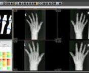 RapidScoreTM is a workflow tool for scoring hand and foot x-rays to document joint damage caused by rheumatoid arthritis.nn* Convenient review of x-ray images by anatomy, study and patientn* Guided Sharp-van der Heijde scoring for hands and feetn* Anatomically-synced pan and zoom for easy reviewn* Images optionally displayed at 2xfilm-size for unbiased readingn* DICOM/PACS connectivityn* Comprehensive reporting