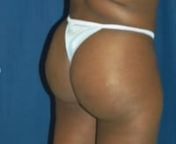 If you want a sensuous body profile with a more prominent buttocks, then the brazilian butt lift is for you!nDr. Ricardo Rodriguez, a Yale trained board certified Plastic Surgeon has been performing this butt augmentation procedure since 2003.Dr. Rodriguez employs highly specialized liposculpting, fat processing, and micro fat re-injection techniques to ensure a long lasting result. nDr. Rodriguez reinjects only highly purified and stem cell rich fat cells. To learn more about the procedure an