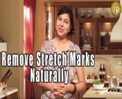 #strechmarks #skincare #marksonskin&#60;br/&#62;In this video our very talented, beautiful TV and Movie Actress &amp; Heath &amp; beauty Expert Mrs Priyanka Saini is telling &#92;
