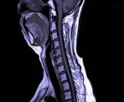 Neuroscience Breakthrough , Could Lead to New Treatments for , Spinal Cord Injuries.&#60;br/&#62;&#39;Newsweek&#39; reports that neuroscientists have &#60;br/&#62;discovered that the human spinal cord is capable of &#60;br/&#62;making its own memories independent of the brain.&#60;br/&#62;The discovery, which challenges previous &#60;br/&#62;ideas about neural circuits outside of the brain,&#60;br/&#62;could represent a breakthrough for people &#60;br/&#62;recovering from spinal cord injuries. .&#60;br/&#62;Learning and memory is&#60;br/&#62;often attributed as functions &#60;br/&#62;of the brain exclusively, Aya Takeoka, principal investigator at Japan&#39;s &#60;br/&#62;RIKEN Center for Brain Science, via &#39;Newsweek&#39;.&#60;br/&#62;Although scientists knew for &#60;br/&#62;more than a century that the &#60;br/&#62;spinal cord could learn and adapt &#60;br/&#62;movements in the absence of brain &#60;br/&#62;input, we did not know how &#60;br/&#62;the spinal cord learns and &#60;br/&#62;memorize what is has learned, Aya Takeoka, principal investigator at Japan&#39;s &#60;br/&#62;RIKEN Center for Brain Science, via &#39;Newsweek&#39;.&#60;br/&#62;Gaining insights into the underlying &#60;br/&#62;mechanism is essential if we want &#60;br/&#62;to understand the foundations &#60;br/&#62;of movement automaticity in &#60;br/&#62;healthy people and use this &#60;br/&#62;knowledge to improve recovery &#60;br/&#62;after spinal cord injury, Aya Takeoka, principal investigator at Japan&#39;s &#60;br/&#62;RIKEN Center for Brain Science, via &#39;Newsweek&#39;.&#60;br/&#62;The team of neuroscientists looked to demonstrate &#60;br/&#62;how spinal cord cells can adapt to sensory inputs &#60;br/&#62;without receiving any signals from the brain.&#60;br/&#62;The two groups of nerve cells have &#60;br/&#62;distinct functions; learning cells are &#60;br/&#62;not needed for recalling what the &#60;br/&#62;spinal cord had learned, and memory &#60;br/&#62;cells were not needed for learning, Aya Takeoka, principal investigator at Japan&#39;s &#60;br/&#62;RIKEN Center for Brain Science, via &#39;Newsweek&#39;.&#60;br/&#62;The team hopes their results could help &#60;br/&#62;develop new rehabilitative training methods &#60;br/&#62;for patients with spinal cord damage.&#60;br/&#62;Not only do these results challenge &#60;br/&#62;the prevailing notion that motor learning &#60;br/&#62;and memory are solely confined to brain &#60;br/&#62;circuits, but we showed that we could &#60;br/&#62;manipulate spinal cord motor recall, &#60;br/&#62;which has implications for therapies &#60;br/&#62;designed to improve recovery &#60;br/&#62;after spinal cord damage, Aya Takeoka, principal investigator at Japan&#39;s &#60;br/&#62;RIKEN Center for Brain Science, via &#39;Newsweek&#39;.&#60;br/&#62;The team&#39;s findings &#60;br/&#62;were published in the &#60;br/&#62;journal &#39;Science.&#39;