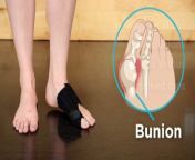In this video, we’ll list several reasons why people love the BraceAbility bunion corrector splint for treatment of a crooked big toe and hallux valgus without surgery.&#60;br/&#62;&#60;br/&#62;Click the link to shop our bunion brace now! - https://www.braceability.com/collections/bunion-corrector-splints&#60;br/&#62;&#60;br/&#62;Here’s a quick recap of the 5 features mentioned in this video:&#60;br/&#62;&#60;br/&#62;1. LIGHTWEIGHT &amp; BREATHABLE&#60;br/&#62;Lightweight and breathable, the bunion splint is made of a ultra soft, open-cell foam for a cool and comfortable fit during extended wear. &#60;br/&#62;&#60;br/&#62;2. ENCLOSED ALUMINUM SPLINT&#60;br/&#62;An enclosed aluminum splint gently realigns your big toe to slow the progression and formation of bunions and crooked toes, while providing pain-relieving support.&#60;br/&#62;&#60;br/&#62;3. FITS IN A SOCK OR LOOSE SHOE&#60;br/&#62;This bunion splint will not slip or bunch and can easily be worn with socks and most styles of shoes, if necessary. Note that wearing tight, narrow shoes might cause bunions or make them worse.&#60;br/&#62;&#60;br/&#62;4. WEAR WHILE SLEEPING&#60;br/&#62;We understand that pain and discomfort doesn’t stop when the sun goes down. Our comfortable and padded, bedtime crooked toe corrector provides moderate realignment of your big toe throughout the night.&#60;br/&#62;&#60;br/&#62;5. ADJUSTABLE TOE WRAP&#60;br/&#62;Easily adjust the durable, ergonomic toe wrap to achieve the perfect fit around your big toe.&#60;br/&#62;&#60;br/&#62;Music: A New Beginning - Bensound.com
